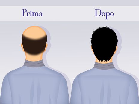 illustration of before and after hair transplantation