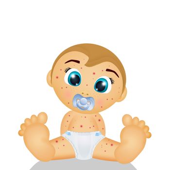 illustration of baby with chicken pox
