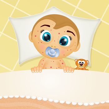 illustration of baby with measles in the bed