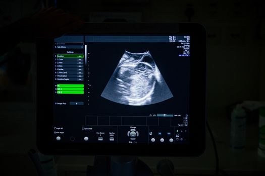 Medical ultrasound machine with a 4D image in a Labor and delivery room at a hospital.