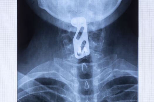 Radiography of titanium plate fixation to support the cervical spine after C5 and C6 vertebrae injury. Provide neck stability using spinal instrumentation concept. 