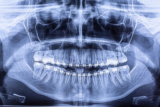 Dental x-ray with braces. Radiography for teeth straightening and dental structures research concept.