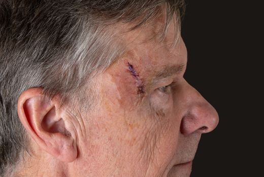Senior adult male with stitches in the cut after surgery for removal of basal cell carcinoma caused by sun damage