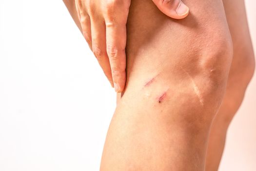 two scratch wound on female knee with big scar closeup, healthcare and medicine concept