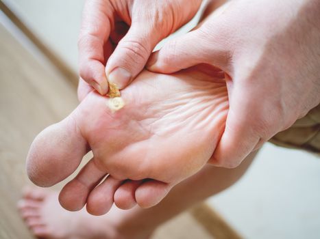 Close up photo of plantar wart on man's foot. Verruca plantaris on the heel is sealed with a salicylic plaster.