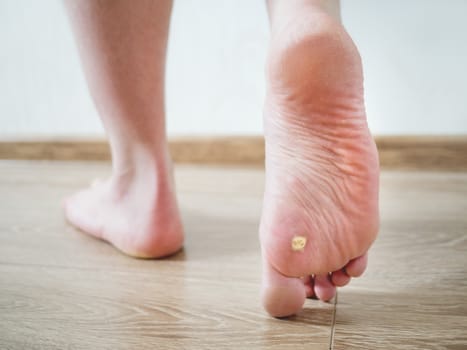 Close up photo of plantar wart on man's foot. Verruca plantaris on the heel.