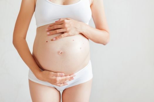 Pregnant woman with many birthmarks (nevus) in white underwear. Young woman expecting a baby.