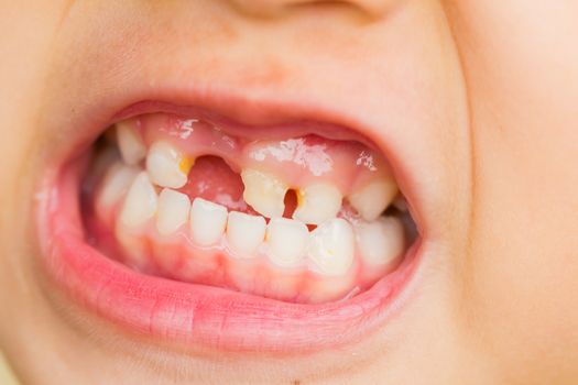 selective focus broken teeth of asian little girl.