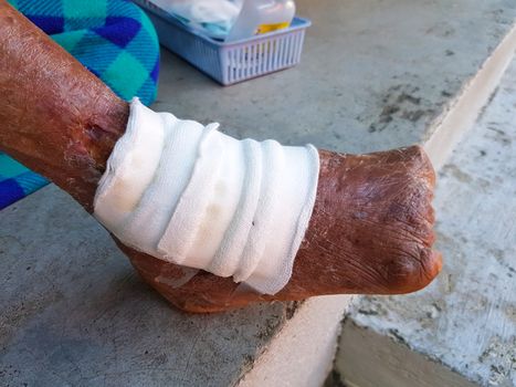 left foot of leprosy woman with gauze