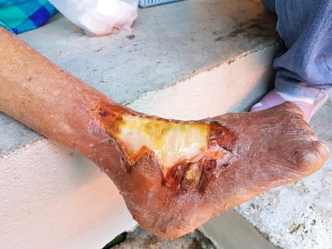 The hot water scalded leprosy woman's foot