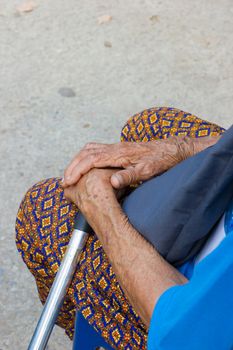 closeup hand of old asian woman suffering from leprosy, amputated hand