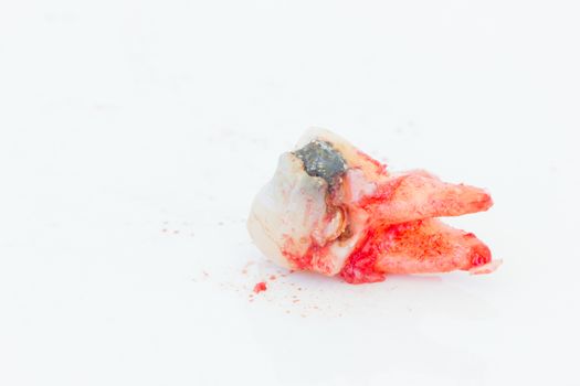 Extraction of decayed tooth on white background.