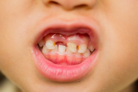 selective focus broken teeth of asian little girl.