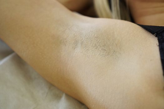 Underarm before epilation photo. Salon wax beautician epilation procedure