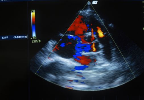 Heart ultrasound image on a computer screen.