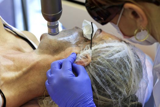 A medical professional makes a mask and laser cleansing and polishing of the skin of the face to the patient.