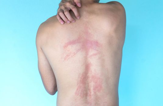 Closeup allergy rash on back skin, health care and medical concept