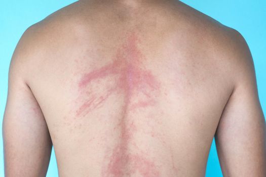 Closeup allergy rash on back skin, health care and medical concept