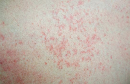 Closeup allergy rash on skin, health care and medical concept