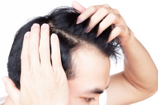 Young man serious hair loss problem for health care medical and shampoo product concept, selective focus