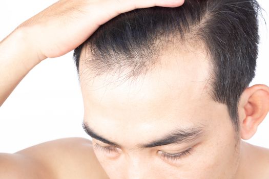 Young man serious hair loss problem for health care medical and shampoo product concept, selective focus