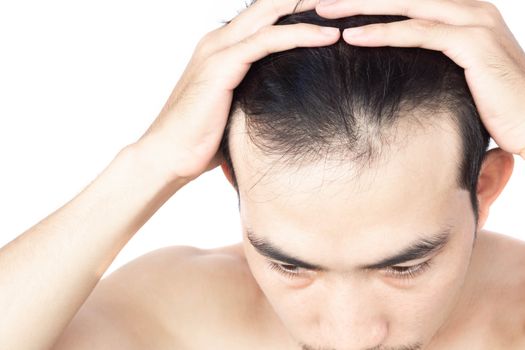 Young man serious hair loss problem for health care medical and shampoo product concept, selective focus