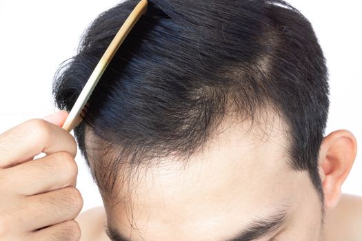 Young man serious hair loss problem for health care medical and shampoo product concept, selective focus