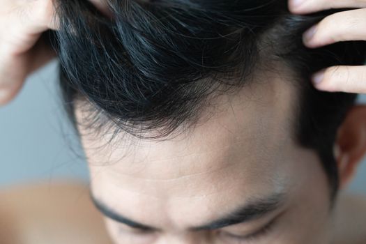 Young man serious hair loss problem for health care medical and shampoo product concept, selective focus