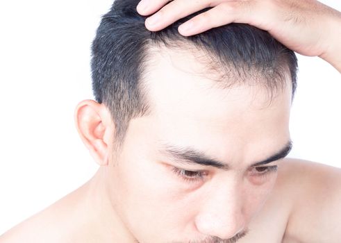 Young man serious hair loss problem for health care medical and shampoo product concept, selective focus