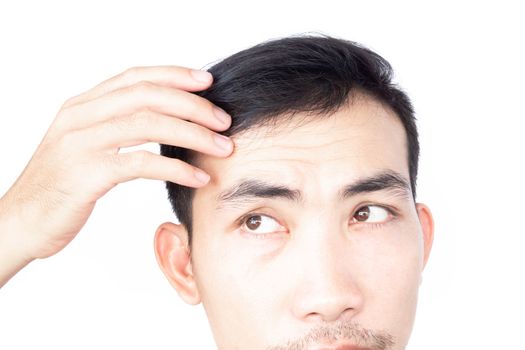 Young man serious hair loss problem for health care medical and shampoo product concept, selective focus