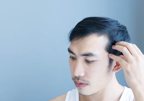 Young man serious hair loss problem for health care medical and shampoo product concept, selective focus