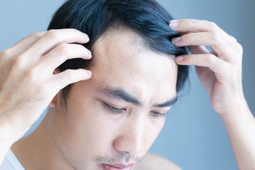 Young man serious hair loss problem for health care medical and shampoo product concept, selective focus