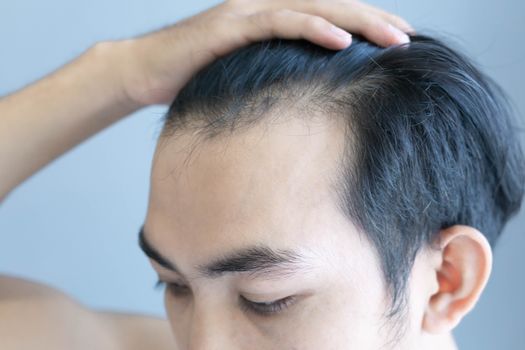 Young man serious hair loss problem for health care medical and shampoo product concept, selective focus