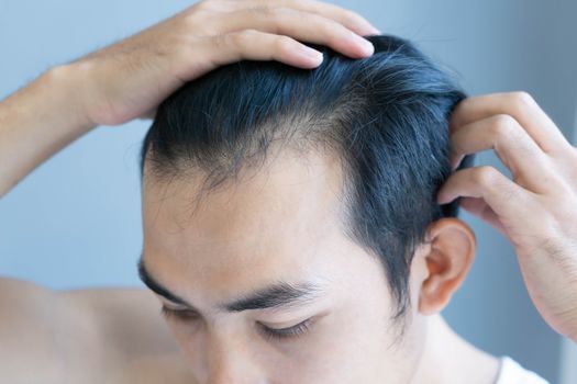 Young man serious hair loss problem for health care medical and shampoo product concept, selective focus