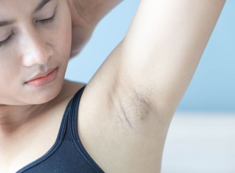 Women problem black armpit lying on white bed background for skin care and beauty concept, selective focus