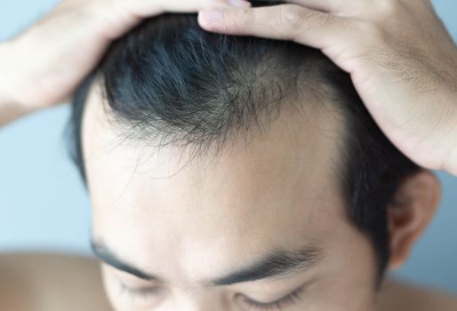 Young man serious hair loss problem for health care medical and shampoo product concept, selective focus