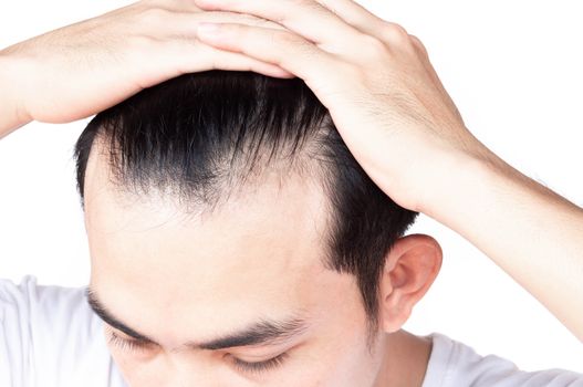 Young man serious hair loss problem for health care medical and shampoo product concept