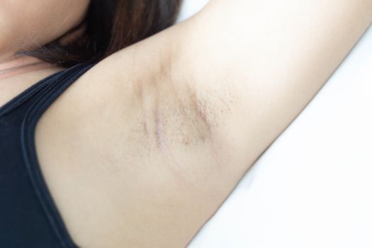 Women problem black armpit lying on white bed background for skin care and beauty concept, selective focus