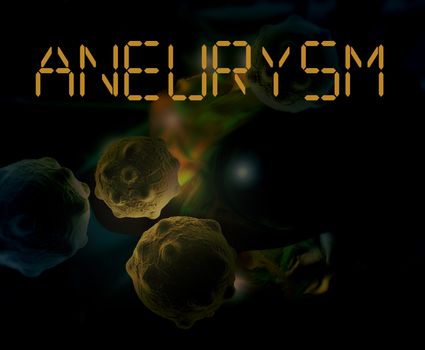 3d Medical illustration of brain aneurysm