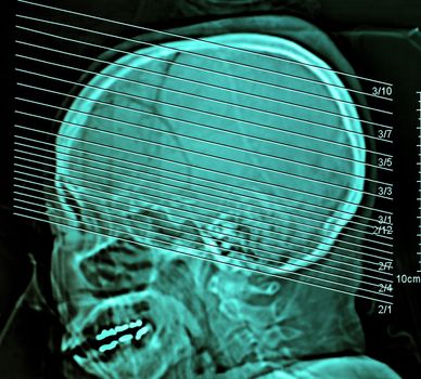 Computerized film x-ray tomography of human brain, CT Scan, Medical concept
