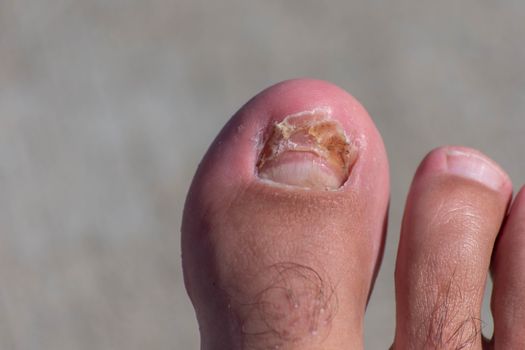 Big toe nail broken off and growing back after an injury.