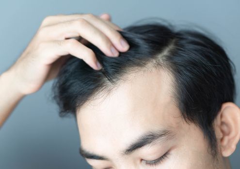 Young man serious hair loss problem for health care medical and shampoo product concept