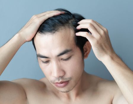 Young man serious hair loss problem for health care medical and shampoo product concept