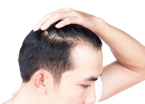 Young man serious hair loss problem for health care medical and shampoo product concept