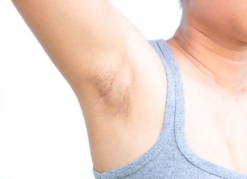 Women problem black armpit on white background for skin care and beauty concept