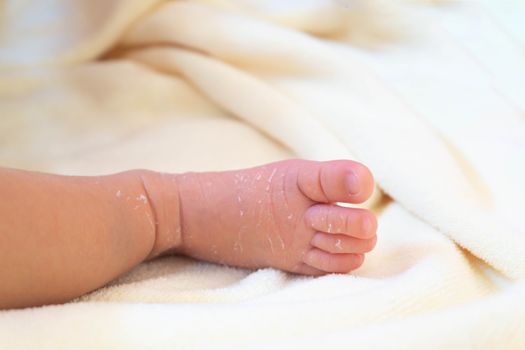 Closeup legs of newborn with peeling skin on white cloth, health care and medical concept, selective focus