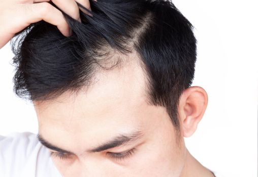 Young man serious hair loss problem for health care medical and shampoo product concept