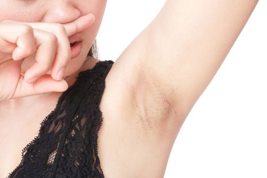 Women problem black armpit on white background for skin care and beauty concept