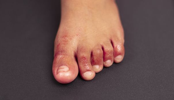 Painful red inflammation on toe called covid toe lesions strange sign of new coronavirus symptoms or infections.
