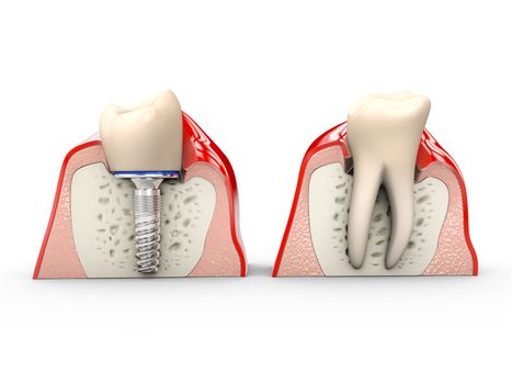 Human teeth and Dental implant 3d Illustration.